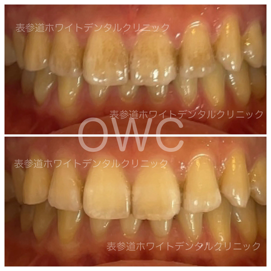 ☆成功するホワイトニングの見分け方と選び方のテクニック - 表参道