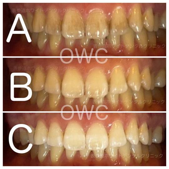 ☆成功するホワイトニングの見分け方と選び方のテクニック - 表参道